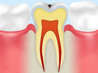 【CO：ごく初期の虫歯】