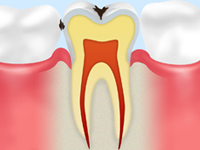 【C1：エナメル質の虫歯】