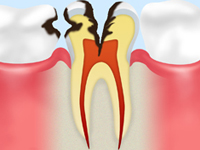 【C2：象牙質の虫歯】