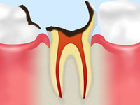 【C3：神経に達した虫歯】