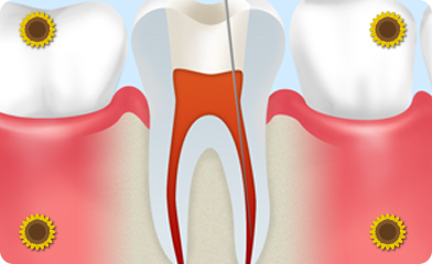 根管治療とは