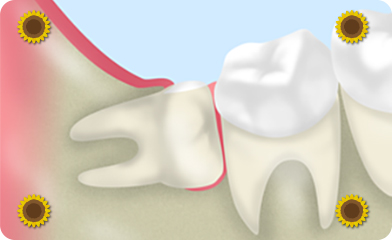 親知らずの抜歯