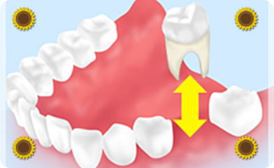 歯牙移植・再植