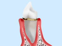 軽度の歯周病（歯肉炎）
