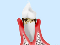 中等度の歯周病（軽度・中等度の歯周炎）