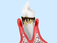重度の歯周病（重度の歯周炎）
